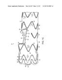 Method For Aortic Branched Vessel Repair diagram and image