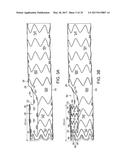 Method For Aortic Branched Vessel Repair diagram and image