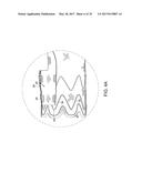 Method For Aortic Branched Vessel Repair diagram and image