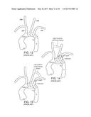 Method For Aortic Branched Vessel Repair diagram and image