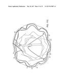 Method For Aortic Branched Vessel Repair diagram and image