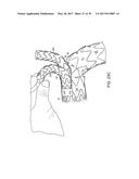 Method For Aortic Branched Vessel Repair diagram and image