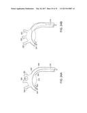 Method For Aortic Branched Vessel Repair diagram and image