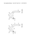 Method For Aortic Branched Vessel Repair diagram and image