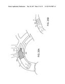 Method For Aortic Branched Vessel Repair diagram and image