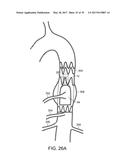 Method For Aortic Branched Vessel Repair diagram and image