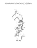 Method For Aortic Branched Vessel Repair diagram and image