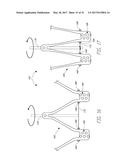 IMPLANTABLE DEVICE AND DELIVERY SYSTEM FOR RESHAPING A HEART VALVE ANNULUS diagram and image
