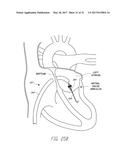 IMPLANTABLE DEVICE AND DELIVERY SYSTEM FOR RESHAPING A HEART VALVE ANNULUS diagram and image