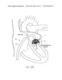 IMPLANTABLE DEVICE AND DELIVERY SYSTEM FOR RESHAPING A HEART VALVE ANNULUS diagram and image