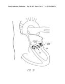 IMPLANTABLE DEVICE AND DELIVERY SYSTEM FOR RESHAPING A HEART VALVE ANNULUS diagram and image