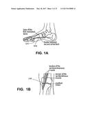 Implantable Electroacupuncture System and Method for Treating Dyslipidemia     and Obesity diagram and image