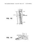 Implantable Electroacupuncture System and Method for Treating Dyslipidemia     and Obesity diagram and image