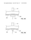 Dilation Device for Placing Catheter Tubes diagram and image