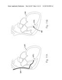 METHODS FOR LOCALIZED DRUG DELIVERY diagram and image