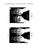 TREATMENT OF AUTOIMMUNE DISEASES WITH DEEP BRAIN STIMULATION diagram and image