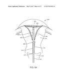 SYSTEMS AND METHODS FOR ENDOMETRIAL ABLATION diagram and image