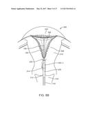 SYSTEMS AND METHODS FOR ENDOMETRIAL ABLATION diagram and image