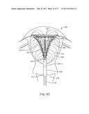 SYSTEMS AND METHODS FOR ENDOMETRIAL ABLATION diagram and image