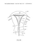 SYSTEMS AND METHODS FOR ENDOMETRIAL ABLATION diagram and image