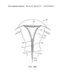 SYSTEMS AND METHODS FOR ENDOMETRIAL ABLATION diagram and image