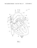 SYSTEMS AND METHODS FOR PRESSURE-REGULATED VOLUME CONTROL DURING     CARDIOPULMONARY BYPASS AND PERFUSION PROCEDURES diagram and image