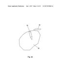 IMPLANT PLACEMENT SYSTEMS, DEVICES AND METHODS diagram and image