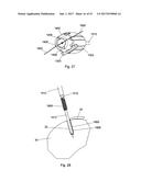 IMPLANT PLACEMENT SYSTEMS, DEVICES AND METHODS diagram and image