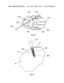 IMPLANT PLACEMENT SYSTEMS, DEVICES AND METHODS diagram and image