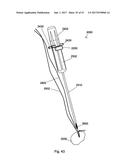 IMPLANT PLACEMENT SYSTEMS, DEVICES AND METHODS diagram and image