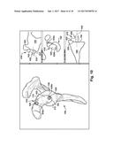 SYSTEM AND METHOD FOR ASSOCIATION OF A GUIDING AID WITH A PATIENT TISSUE diagram and image