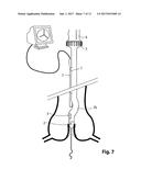 Device For Cutting Off And Removing Calcified Tissue From A Heart Valve diagram and image