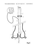 Device For Cutting Off And Removing Calcified Tissue From A Heart Valve diagram and image