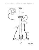 Device For Cutting Off And Removing Calcified Tissue From A Heart Valve diagram and image