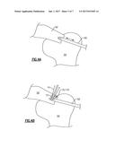 SOFT ANCHOR ASSEMBLY WITH NON-SLIDING FLEXIBLE STRAND AND TECHNIQUES FOR     USE diagram and image