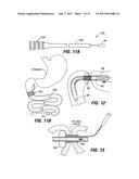 INTESTINAL SLEEVES AND ASSOCIATED DEPLOYMENT SYSTEMS AND METHODS diagram and image