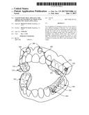 CUSTOM MADE ORAL APPLIANCE FOR AIRWAY MANAGEMENT OF THOSE WITH OBSTRUCTIVE     SLEEP APNEA (OSA) diagram and image