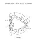 CUSTOM MADE ORAL APPLIANCE FOR AIRWAY MANAGEMENT OF THOSE WITH OBSTRUCTIVE     SLEEP APNEA (OSA) diagram and image