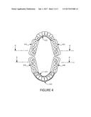 CUSTOM MADE ORAL APPLIANCE FOR AIRWAY MANAGEMENT OF THOSE WITH OBSTRUCTIVE     SLEEP APNEA (OSA) diagram and image