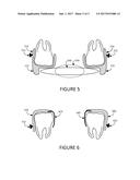 CUSTOM MADE ORAL APPLIANCE FOR AIRWAY MANAGEMENT OF THOSE WITH OBSTRUCTIVE     SLEEP APNEA (OSA) diagram and image