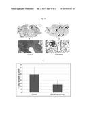 Desethylamiodarone for use in cancer treatment diagram and image