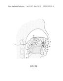 METHODS AND SYSTEMS FOR IMPROVING AIRWAY PATENCY diagram and image