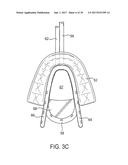 METHODS AND SYSTEMS FOR IMPROVING AIRWAY PATENCY diagram and image