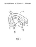 METHODS AND SYSTEMS FOR IMPROVING AIRWAY PATENCY diagram and image