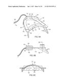 METHODS AND SYSTEMS FOR IMPROVING AIRWAY PATENCY diagram and image