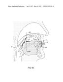 METHODS AND SYSTEMS FOR IMPROVING AIRWAY PATENCY diagram and image