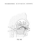 METHODS AND SYSTEMS FOR IMPROVING AIRWAY PATENCY diagram and image