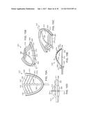 METHODS AND SYSTEMS FOR IMPROVING AIRWAY PATENCY diagram and image