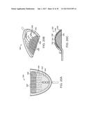 METHODS AND SYSTEMS FOR IMPROVING AIRWAY PATENCY diagram and image