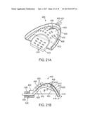 METHODS AND SYSTEMS FOR IMPROVING AIRWAY PATENCY diagram and image